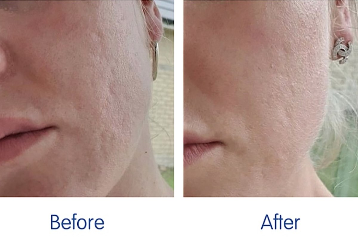 میکرونیدلینگ جای جوش