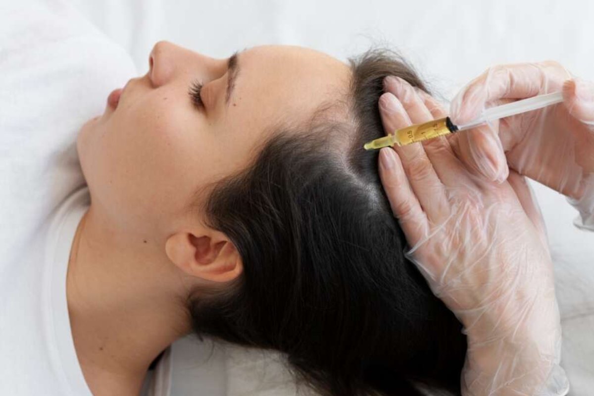 کاربردهای PRF صورت و مو